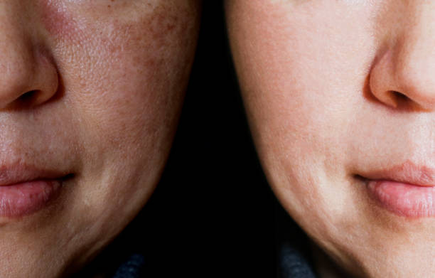Pigmentvlekken & Hyperpigmentatie