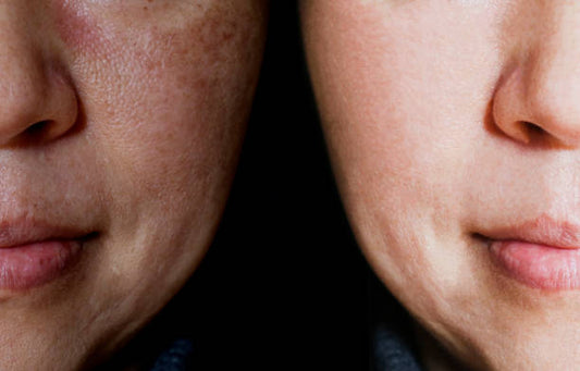 Pigmentvlekken & Hyperpigmentatie