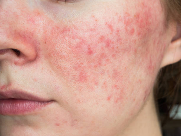 Gevoelig - Rood - Couperose - Rosacea